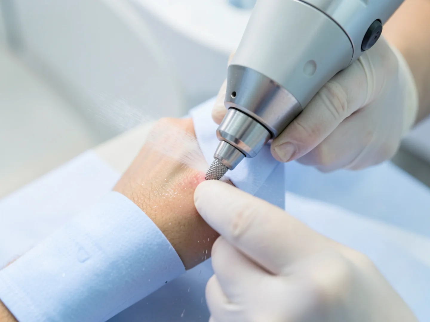 Dentist refining porcelain veneer margin with diamond bur under water spray